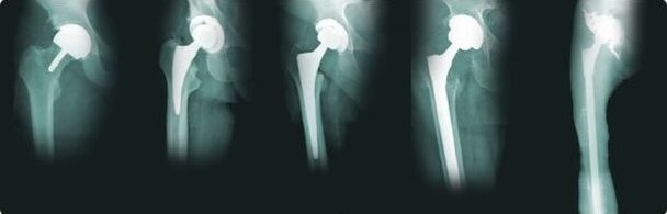 Hip replacement options for osteoarthritis