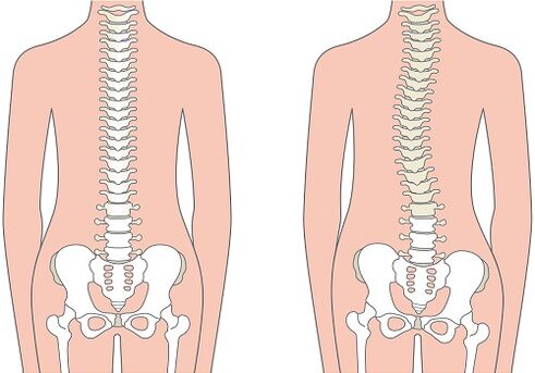Lower back pain due to a spinal deformity such as scoliosis
