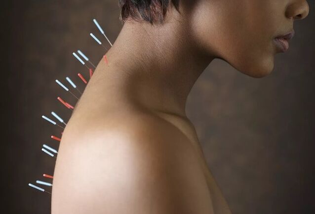 acupuncture