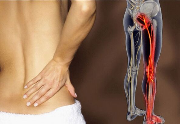 sciatica