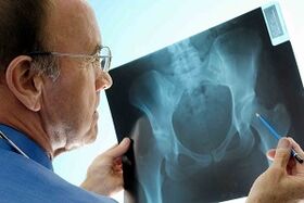 Arthrosis of the hip joint on the X rays