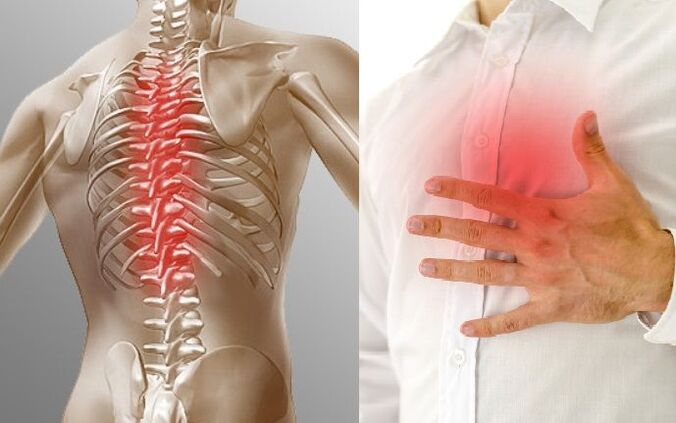 Breast osteochondrosis and breast pain