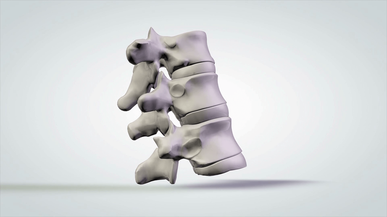 Damage to the spine caused by cervical osteochondrosis