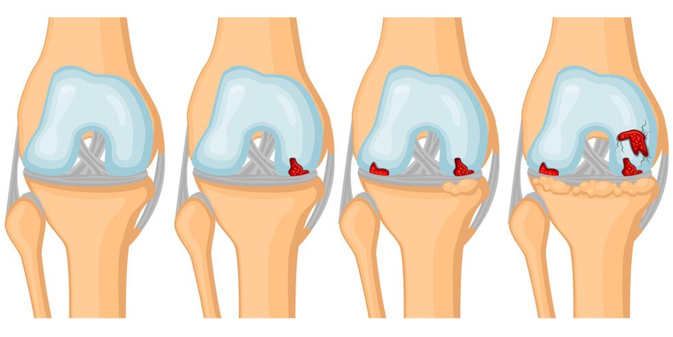 Degree of development of joint arthrosis