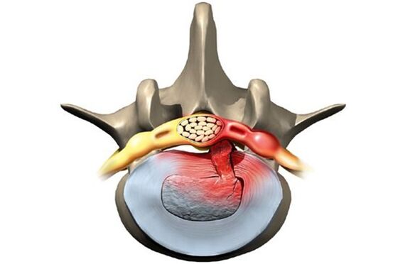 Vertebra affected by osteochondrosis