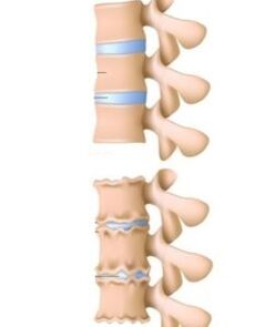 Causes of osteochondrosis